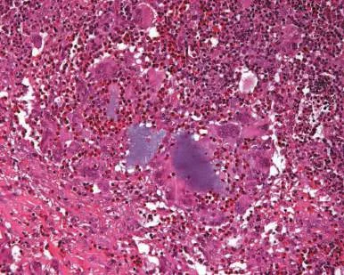 Fig 8. Histology of an inflammatory/granulomatous foreign-body reaction to hyaluronic acid: a mixed inflammatory infiltrate surrounds amorphous filler material in the dermis. Histology is what separates granuloma from simple malposition when the phenotype is late and firm.