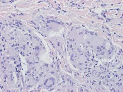 Fig 9. Histology of poly-L-lactic acid (PLLA) granuloma formation: epithelioid macrophages and multinucleated giant cells around birefringent particulate material. Because PLLA and other particulate biostimulators cannot be enzymatically dissolved, a granuloma here commits the patient to a longer intralesional/anti-inflammatory pathway, unlike an HA reaction.