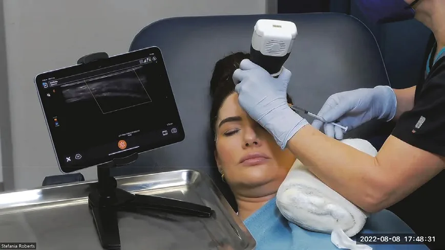 Fig 10. Real-time high-frequency ultrasound guiding a facial injection: the probe images the plane and any existing implanted material before the needle enters. In a poly-treated or device-plus-injectable field, this is how the operator confirms product location and avoids depositing energy or product into an unmapped or inflamed depot.